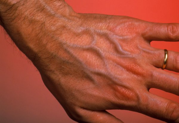 正规合法股票配资平台 为什么有的人手上青筋暴起？这些地方出现青筋一定要小心